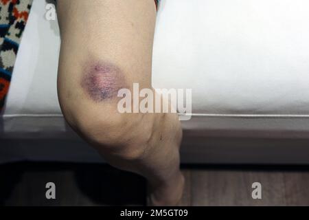 Blaue Flecken auf der Haut ihres Beins Stockfoto