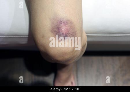 Blaue Flecken auf der Haut ihres Beins Stockfoto