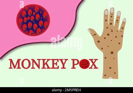 Ein Banner mit dem Affenpocken-Virus. Affen Pocken Virus Ausbruch Pandemie Design mit mikroskopischem Ansichtshintergrund. Hand zeigt Zeichen und Symptome. Stockfoto