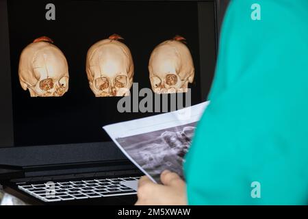 3D Computertomographie des Gehirns mit einem Bruch des frontalen Schädelteils nach einer Verletzung auf Laptop-Bildschirmen auf dem Tisch auf Laptop-Bildschirmen bei Stockfoto