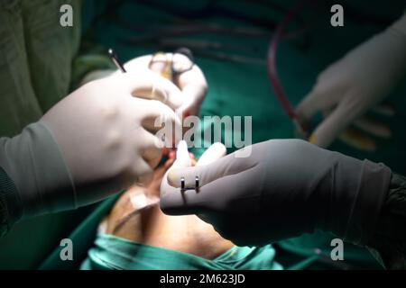 Rhinoplastik-Chirurgie, Defekte der Nasenform bei der Patientin. Chirurgische Eingriffe bei plastisch-chirurgischen Rhinoplastiken Stockfoto