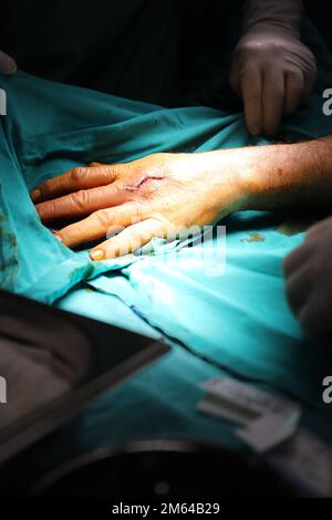 Die Behandlung der Nerven- und Gefässruptur. Plastischer Chirurg Arzt behandelt Hand durch Mikrochirurgie Stockfoto