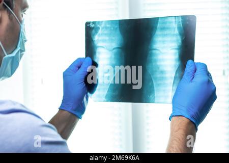 Arzt hält Röntgenfilm in den Händen. OA-Knie-Röntgenbild Posteo-anteriore Ansicht, OA-Kniediagnostik. Stockfoto