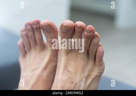 Beschädigte einen großen Nagel am männlichen Fuß. Stockfoto