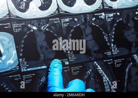 Arzt aufmerksam untersucht die MRT der Patienten scannen Stockfoto