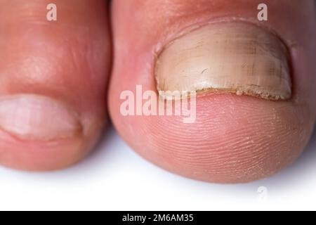 Nahaufnahme eines Fingers mit Nagelpilzinfektion, Stockfoto