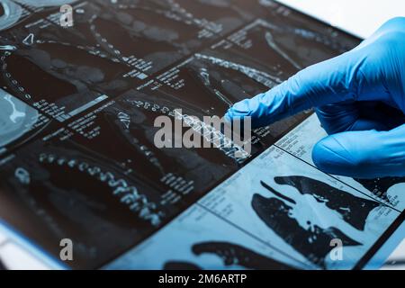 Arzt aufmerksam untersucht die MRT der Patienten scannen Stockfoto