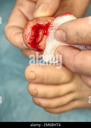 Nagelriss und Nagelbettblutung am kindlichen Bein. Sehr schmerzhafte Verletzung des Nagels des großen Zehens. Stockfoto