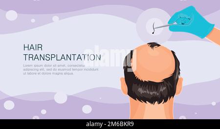 Haarausfall. Stadien der Alopezie Mann Problem Vektor medizinische Gesundheit Illustration Haartransplantation Illustration Stock Vektor