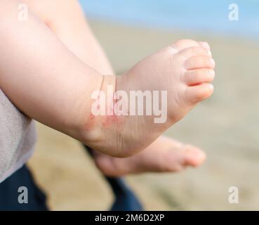 Atopisches Ekzem der Neugeborenen-Dermatitis Stockfoto