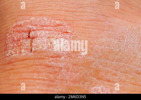 Psoriasis trockene rote und weiße Reizung an der Hautabnahmung. Stockfoto