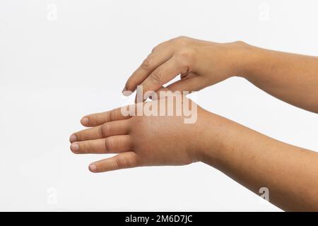 Geschwollene Hand durch allergische Insektenstiche. Hautallergische Pflege. Stockfoto