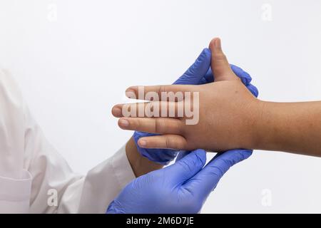 Geschwollene Hand durch allergische Insektenstiche. Hautallergische Pflege. Stockfoto