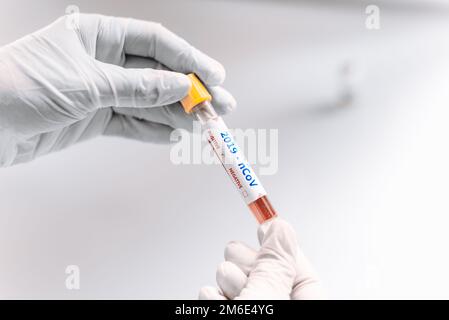 Positives Bluttestergebnis für das neue, sich schnell ausbreitende Coronavirus. Stockfoto