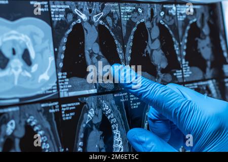 Arzt aufmerksam untersucht die MRT der Patienten scannen Stockfoto