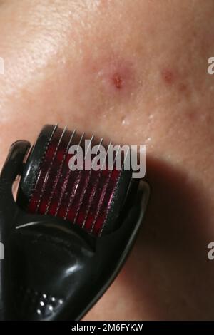 Gesichtsmassage mit Mikroneedle Dermaroller zur Behandlung von Narben, Falten und zur Gesichtsverjüngung. Einfache und billige Hautpflege zu Hause, clos Stockfoto