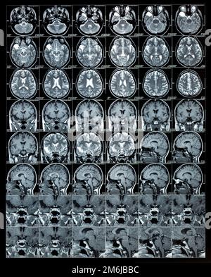 MRT-Hirnscan oder Magnetresonanzbildergebnisse, neurologisches Konzept Stockfoto