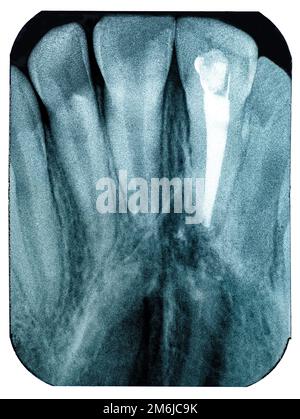 Röntgenbildgebung des oberen Eckwurzelkanals Stockfoto
