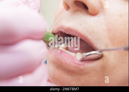 Prothesenset. Nahaufnahme von Zähnen. Zahnarzt untersucht einen Patienten Stockfoto
