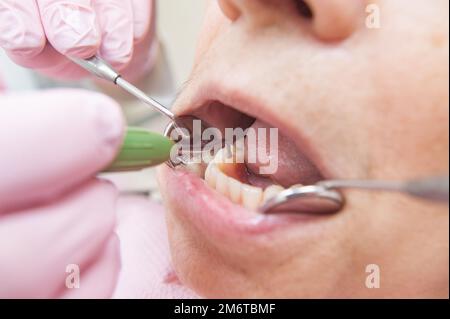Prothesenset. Nahaufnahme von Zähnen. Zahnarzt untersucht einen Patienten Stockfoto