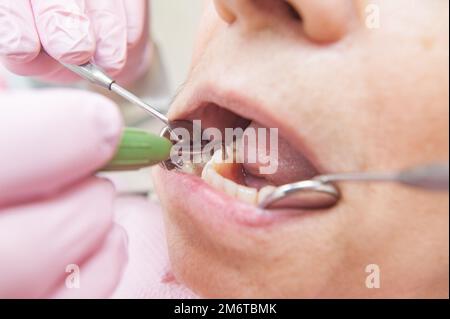 Prothesenset. Nahaufnahme von Zähnen. Zahnarzt untersucht einen Patienten Stockfoto