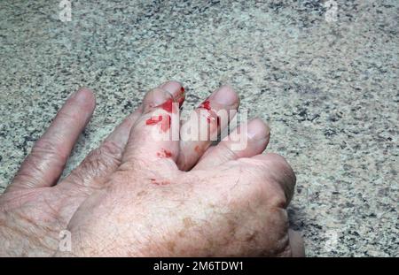 Schnitt oder verletzte Fingerblutung. Stockfoto