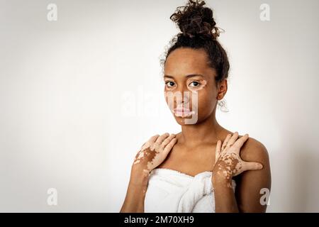 Wunderschöne junge afroamerikanische Frau mit Vitiligo posieren mit Handtuch, Hautpflege und genetischen Pigmentierungskonzepten, lächelnden Menschen und positivem Körper Stockfoto