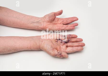 Postoperativ geschwollene Dupuytren'sche Kontraktur der rechten Hand mit entferntem Naht und Strich. Ansicht zeigt die linke Hand desselben Patienten. Stockfoto