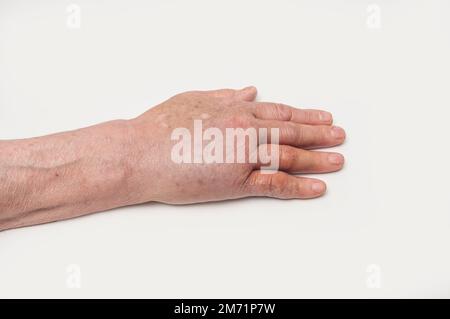 Die Spitze der postoperativen geschwollenen Dupuytren'schen Kontraktur der rechten Hand. Stockfoto