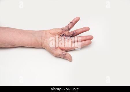 Postoperativ geschwollene Dupuytren'sche Kontraktur der rechten Hand mit entferntem Naht und Strich Stockfoto