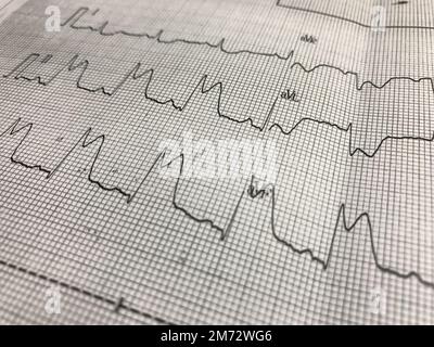 Nahaufnahme der ST-Hebung in den Ableitungen I, II auf EKG-Papier Stockfoto