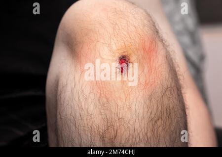 Nahaufnahme der frischen Wunde am Knie des Mannes vor Unfall. Stockfoto