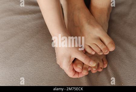 Frau mit Füßen mit subungualem Hämatom, schwarzer Zehennagel durch Trauma, Pilzinfektion oder Chemotherapie.Person mit Onychomykose, A Stockfoto