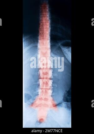 Röntgen des Wirbelsäulenskeletts. Rote Schmerzen auf den Knochen Stockfoto