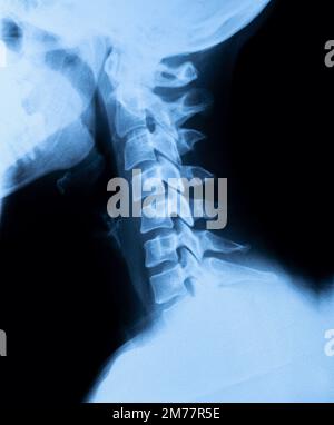 Nahaufnahme der Röntgenaufnahme des schmerzhaften Bereichs der Halswirbelsäule Stockfoto