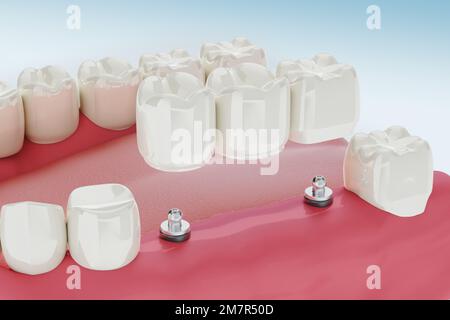 3drendering, Pfeiler, Antibiotikum, künstlich, Schönheit, Pflege, Hohlraum, Krone, Delle, Zahnpflege, Dentin, Zahnarzt, Zahnheilkunde, Zahnprothese, Zahnschmelz, Ausrüstung, Frac Stockfoto