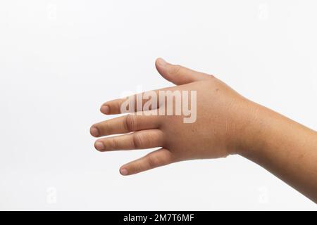 Geschwollene Hand durch allergische Insektenstiche. Hautallergische Pflege. Stockfoto