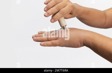 Eine Frau trägt eine Creme auf die geschwollene Hand auf, die durch eine allergische Insektenstichung verursacht wurde. Hautallergische Pflege. Stockfoto