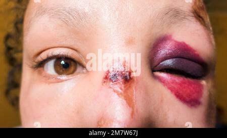 Mädchen mit dem Schwarzen Auge, Shiner. Schließen. Großer Bluterguss unter den Augen Stockfoto