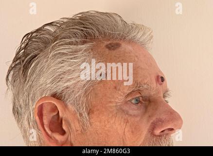 Keratoakanthom-Hautkrebswachstum auf einer männlichen Stirn. Keratoakanthom ist ein niedrig maliger, schnell wachsender, 1 bis 2 cm breiter kuppelförmiger Hauttumor. Stockfoto