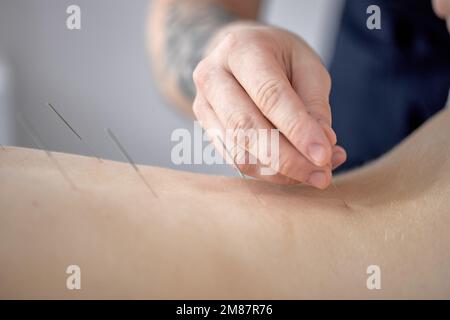 Akupunktur im Rücken eines weiblichen, nicht erkennbaren männlichen Massagisten, der eine Osteoarthritis-Behandlung im Rücken der Wirbelsäule zur Rehabilitation im Klinikspital durchführt. clos Stockfoto
