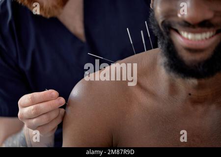 Akupunkturtherapie an der Rückenwirbelsäule bei schwarzem männlichen Klienten. Gekürzter Mann, der sich einer Akupunkturbehandlung mit einer Linie feiner Nadel I unterzieht Stockfoto