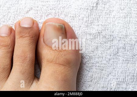 Hochwinkelschuss eines Fingers mit Nagelpilzinfektion auf einem weißen Handtuch Stockfoto