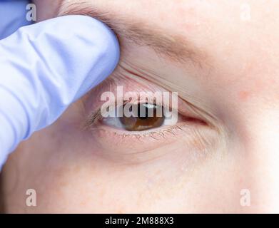 Nahaufnahme eines weiblichen Auges mit bakterieller Infektion einer Öldrüse im Unterlid.
