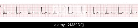 Banner- oder EKG-Beispiel eines normalen Sinusrhythmus Stockfoto