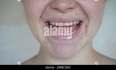 Ein junges Mädchen lächelt und zeigt schiefe Zähne. Der Begriff der zahnärztlichen Probleme Stockfoto