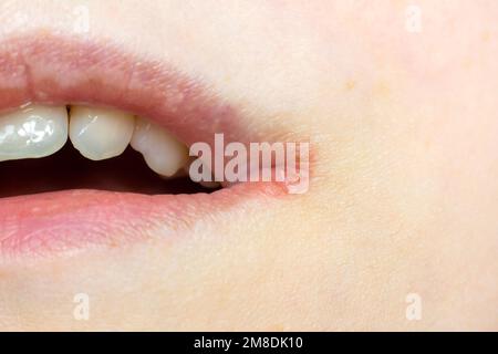 Frau Lippen Haut mit Herpes labialis Virus Nahaufnahme. Stockfoto