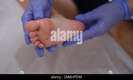 Ausschlag mit Enterovirusinfektion der Picornavirus-Familie an den Füssen des Kindes Stockfoto