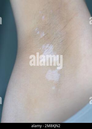 Nahaufnahme einiger weißer Vitiligo-Hautflecken in der rechten Achselhöhle einer kaukasischen Frau Stockfoto