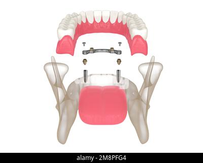 3D Render der Stange Retention Removable Overdenture Installation Support by two Implantates over white Stockfoto